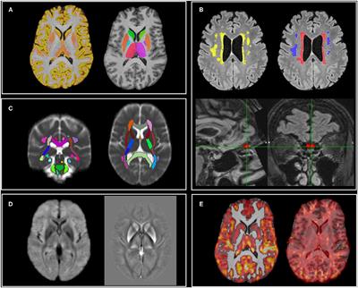 Adapting the UK Biobank Brain Imaging Protocol and Analysis Pipeline for the C-MORE Multi-Organ Study of COVID-19 Survivors